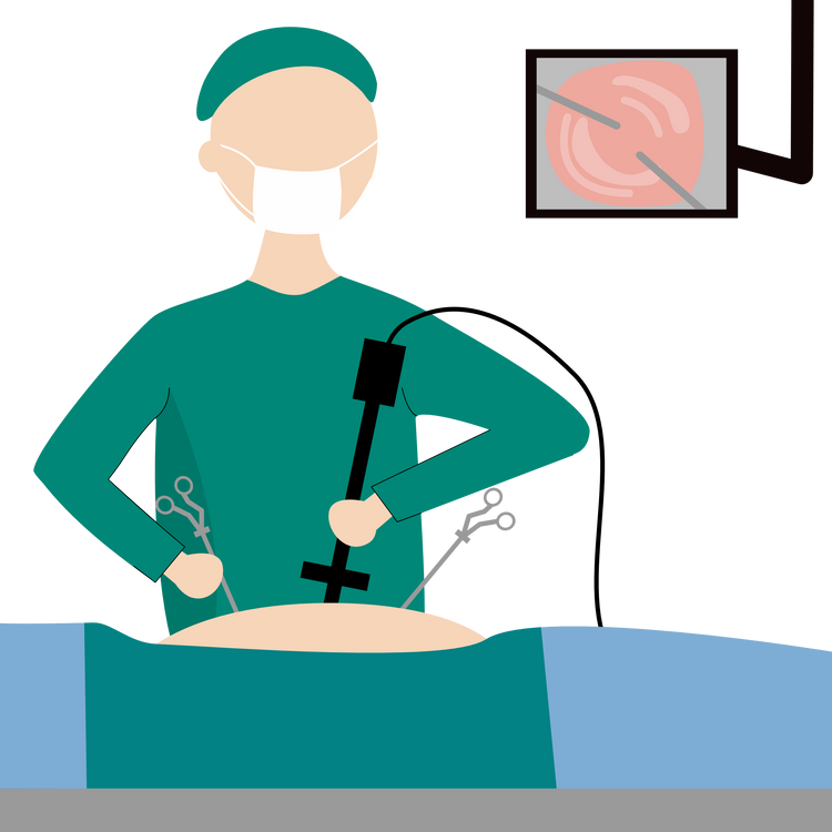 Laparoscope Surgery Illustration