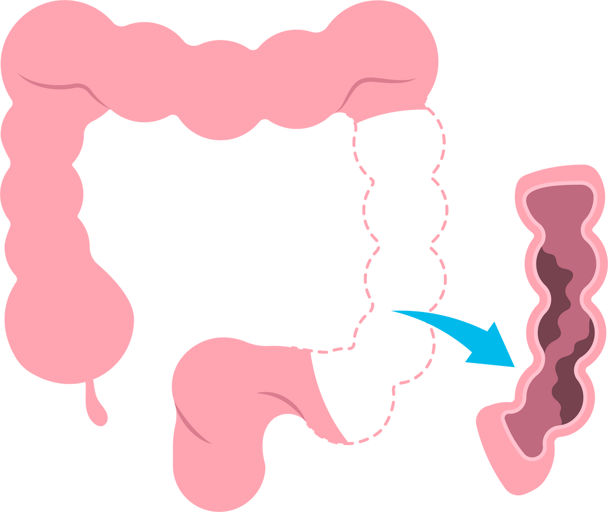 surgery treat stoma belly Hernia bowel tumor  stomach ileostomy bag ulcerative syndrome crohn's Irritable polyp proctocolectomy colitis  prolapse large colonic inertia